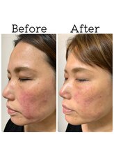 ナチュライズ(NatuRise)/リフトアップ・赤み改善美容鍼