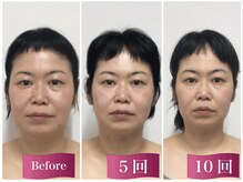 【四角顔/エラ張り】40代女性×お顔が四角く大きくなってきた