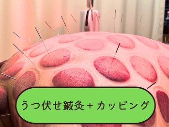 仁接骨院 じん鍼灸治療院/カッピング+鍼