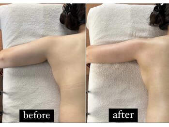 きれい 渋谷恵比寿店/二の腕スッキリ1回Before/After