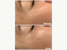 アンフェム(Anfem)/水光ボツリヌスフェイシャル