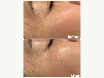 アンフェム(Anfem)/水光ボツリヌスフェイシャル