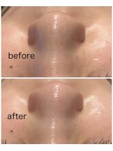 フェリーチェ(Felice)/黒ずみスッキリ