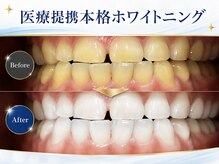 メルヴェイユ/本格医療提携ホワイトニング
