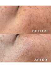 カウニス るる(kaunis)/【ララピール】Before After