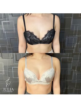 ジュリア(JULIA)/【バストアップ/育乳　症例】