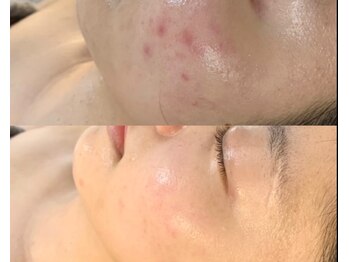 ルミエール シーサイド(L’MIERE seaside)/肌荒れ改善