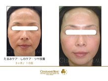 エステサロン リアルケー(Real K)/シャルム・ボービフォーアフター