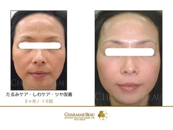 エステサロン リアルケー(Real K)/シャルム・ボービフォーアフター