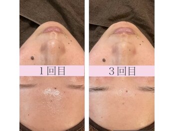 堺整骨院 小郡院/毛穴洗浄