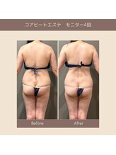 エクラ(ECLAT)/コアヒート痩身