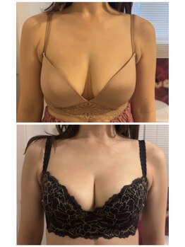 ビービリア(B.villea)/バストアップ施術1回