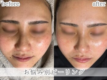 ミック(Mecc)/お悩み別ピーリング60分