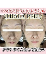 アルムダアクア 天王寺店(Aleumda AQUA)/ハーブピーリング/大阪/天王寺