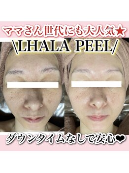 アルムダアクア 天王寺店(Aleumda AQUA)/ハーブピーリング/大阪/天王寺