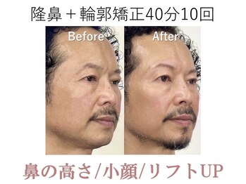 ラプリ 大阪心斎橋店(Raplit)/隆鼻＋輪郭矯正40分20回