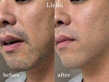 リエラ(Liella)の雰囲気(髭脱毛12回目効果◎別人並にトーンアップも叶う☆脱毛/顔脱毛)