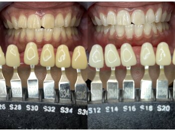 トウキョースワーズ 渋谷店(TOKYO SWRS)/#ホワイトニング #渋谷 #池袋