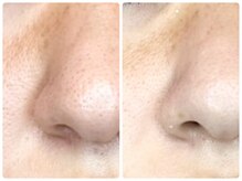 ラウン 京都(ROUN')/EIEN毛穴洗浄1回の施術