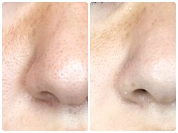 ラウン 京都(ROUN')/EIEN毛穴洗浄1回の施術