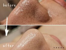 ボウ 静岡本店(VOEUX)/20代　毛穴いちご鼻　11回