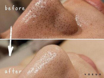 ボウ 静岡本店(VOEUX)/20代 毛穴いちご鼻 11回