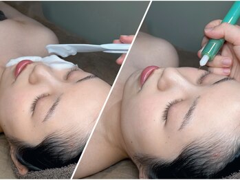リル バイ アンドアール(Rire by and.R)の写真/【冬でもできるシミケア】痛み少なく、ダウンタイムの心配なし！ピンポイントに根元からシミにアプローチ◎