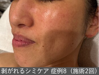 オアシスラグーン(OASIS LAGOON)/シミケア(症例8 施術2回)50代