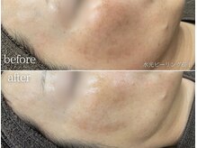 ミレット(Miretto)/【シミ・透明感】水光ピーリング