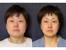 美容整体 アルマ/頭とエラ