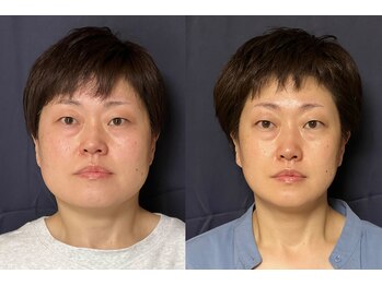 美容整体 アルマ/頭とエラ