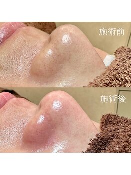 エクラ バイ シャンリィ(eclat by shanLy)/ツルツルのお肌に