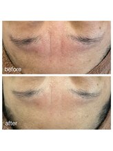 美温(mion)/眉間に溜まりやすいコリとシワ