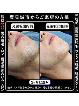 ディースタイル 北谷店(Dstyle)/北谷メンズ脱毛ヒゲBefore after