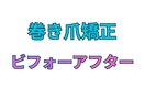 巻き爪矯正 ビフォーアフター