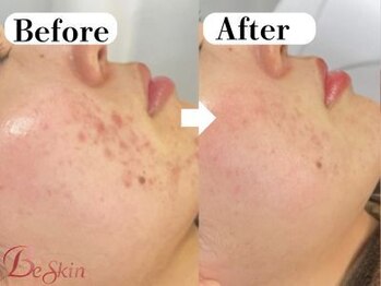 ビースキン 広島(BE:SKIN)/ハーブピーリング/ニキビケア