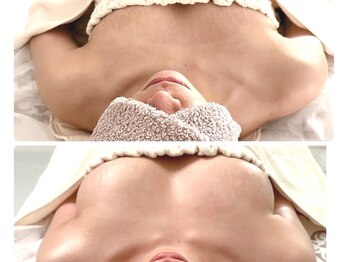 リソラ(risora)/バストアップ症例