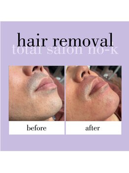 ヌック(NO-K)/ヒゲ脱毛