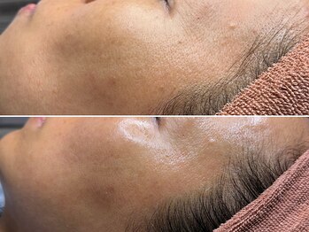 ハス(hasu.)/水光肌にリジュラン初回の結果