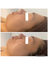 ミュウ(Myu)/フェイシャル