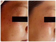 ベルドア(Bell Door)/【ハーバルピーリング】６回後