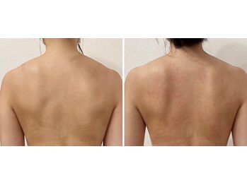 リネア(Linea)/バスト以外の効果も実感