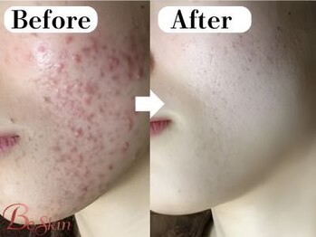 ビースキン 広島(BE:SKIN)/ハーブピーリング/ニキビケア