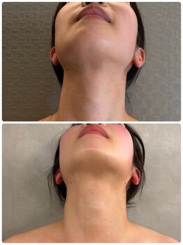 アリィ(Alii)/左右差改善/綺麗な顎ライン