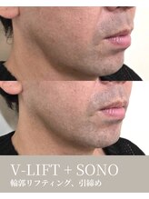 エムネ ラボ 大阪本町(M/NE &nbsp;LAB)/V-LIFT＋SONO　リフティング