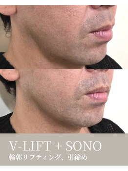 エムネ ラボ 大阪本町(M/NE LAB)/V-LIFT+SONO リフティング