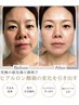 【ほうれい線・たるみ. 眼精疲労】最先端小顔術 ×全身エイジングケア120分