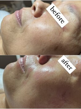 スパークル/リフトアップ/毛穴/しわ予防