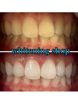 ホワイトニングショップ 京都駅前店/40分×20回Before/After