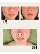 ヴィヴ コレビ(VIV COREBI)/REVIのスキンケア